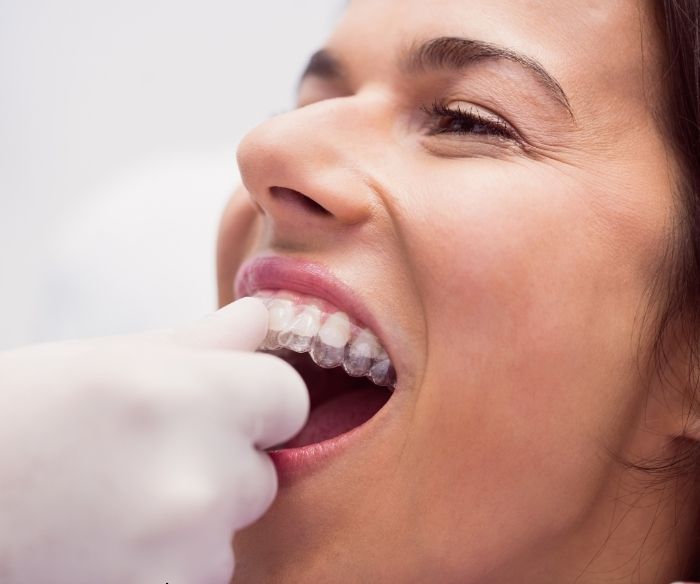 alineadores invisibles personalizados